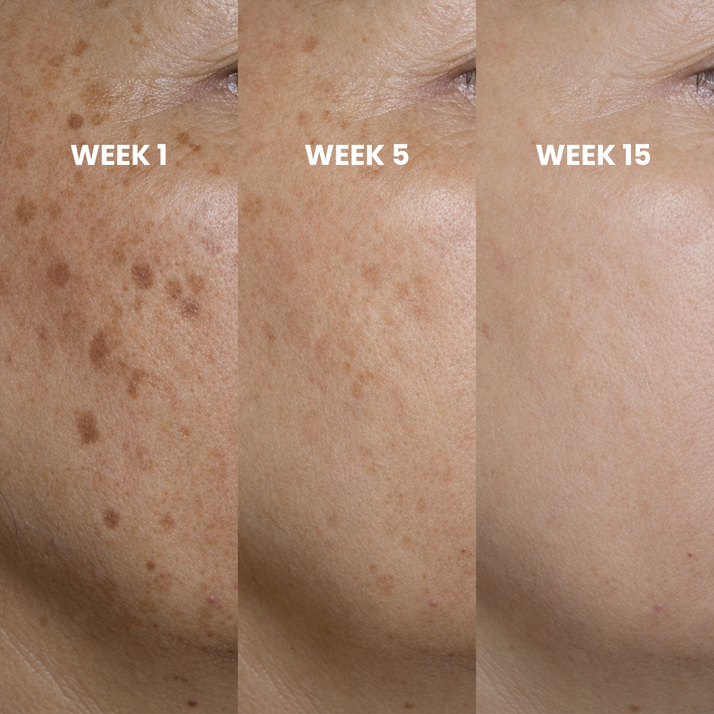 Peptide Microinfusion