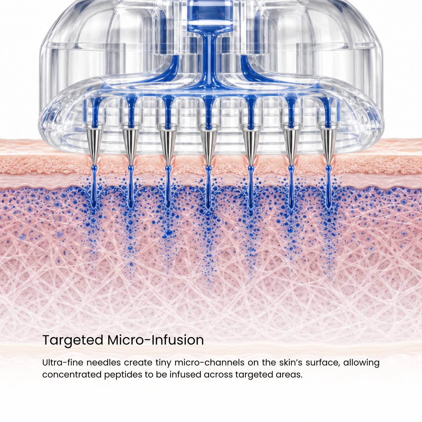 Peptide Microinfusion