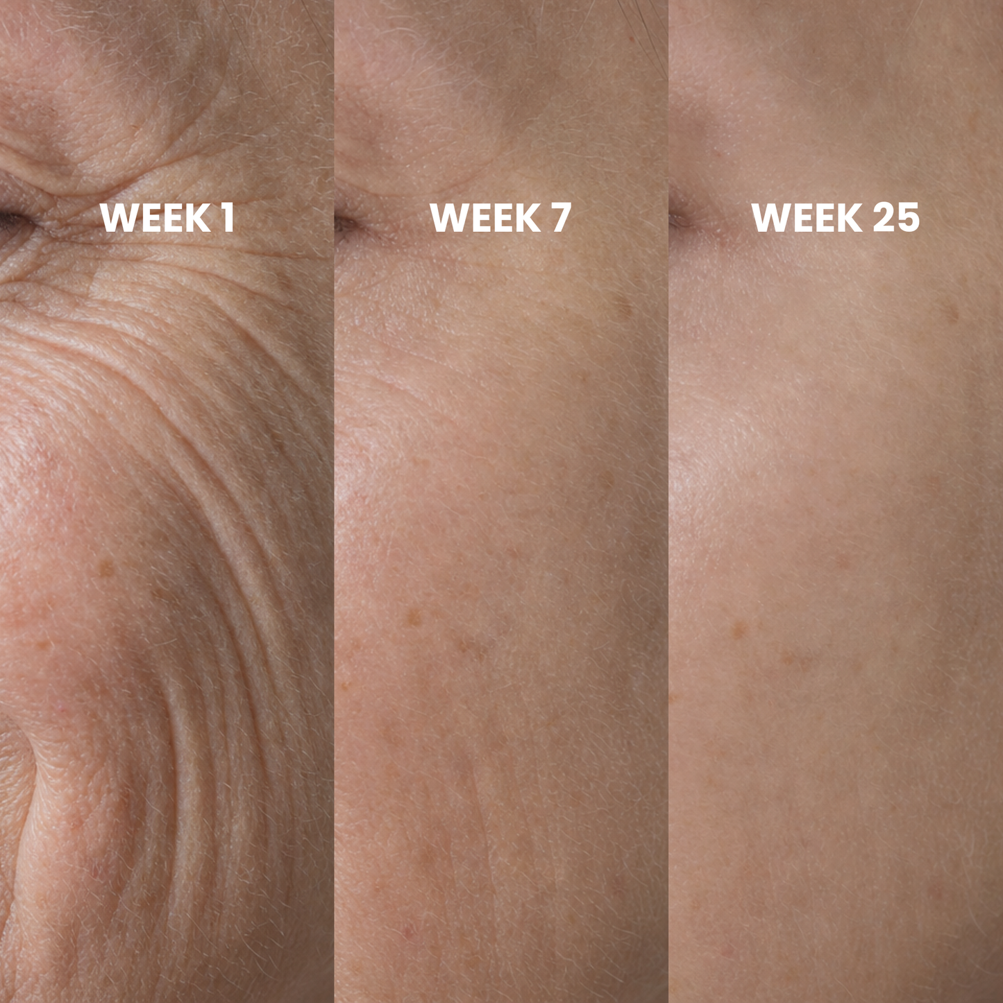 Peptide Microinfusion
