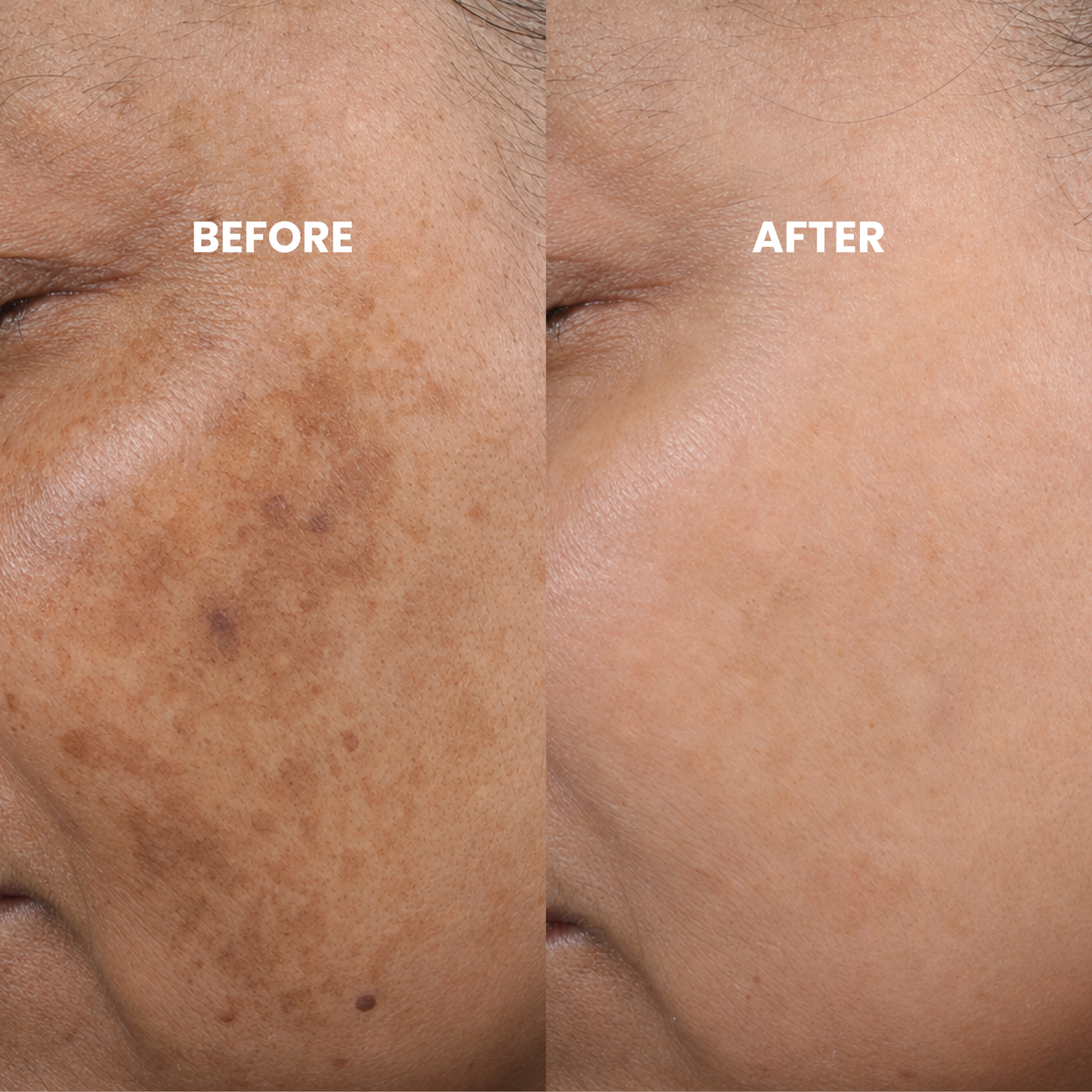 Peptide Microinfusion