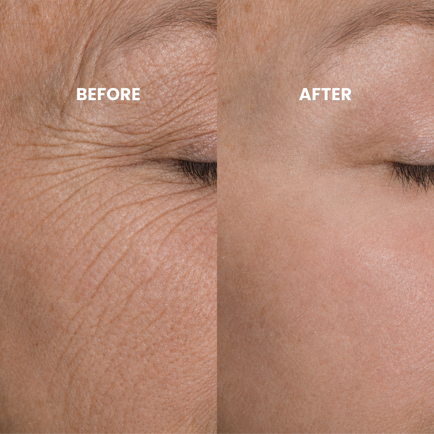 Peptide Microinfusion
