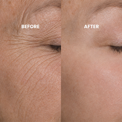 Peptide Microinfusion